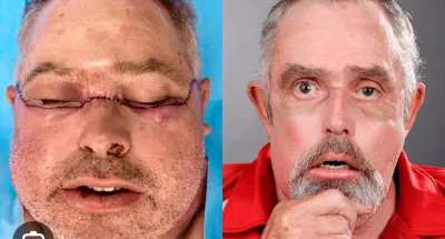 la-peau-du-visage-dun-donneur-recemment-decede