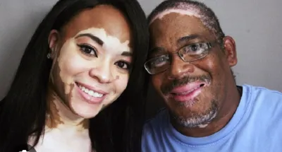 sante-voici-le-traitement-qui-peut-freiner-le-vitiligo