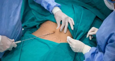 les-dangers-de-loperation-de-chirurgie-esthetique-des-fesses
